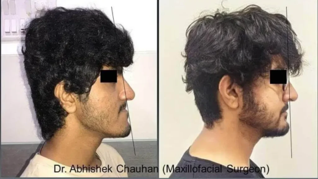 Orthognathic Surgery