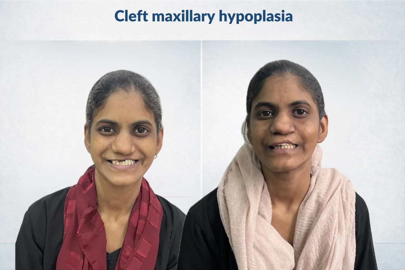 Cleft maxillary hypoplasia